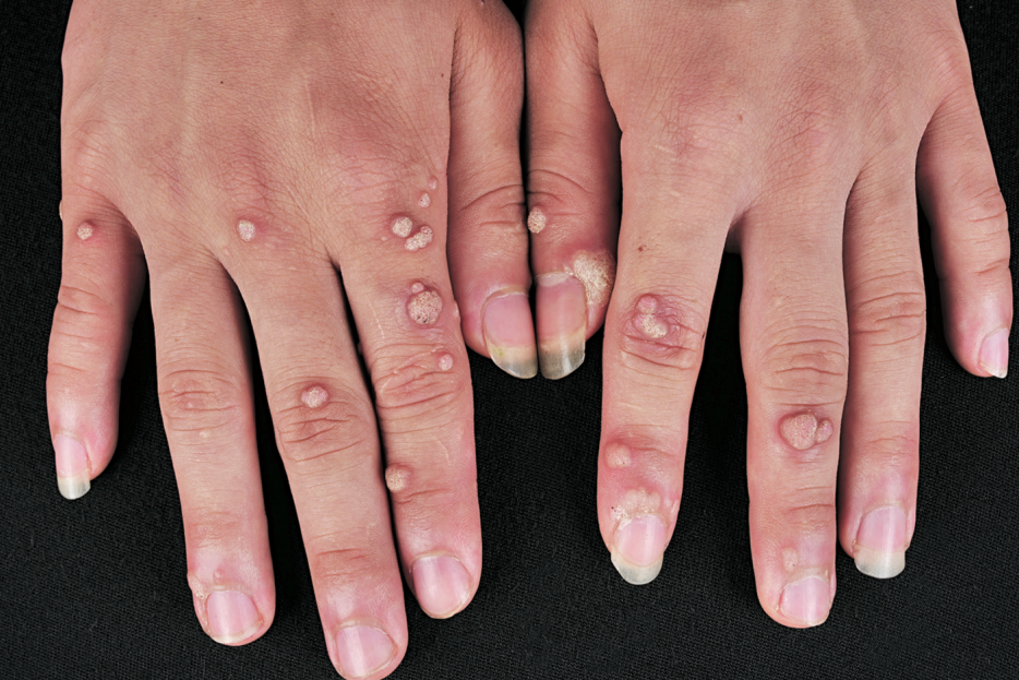 病毒疣是怎样引起的